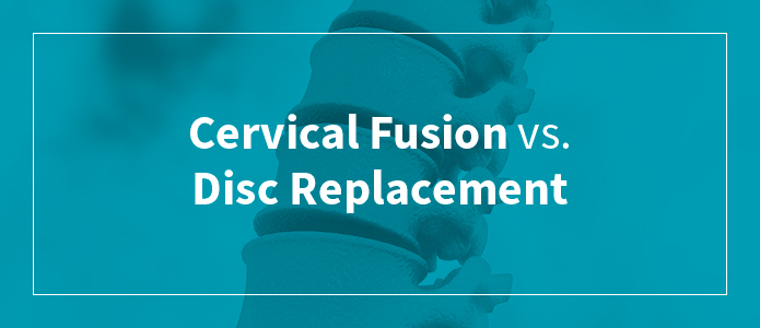 Cervical Fusion vs. Disc Replacement