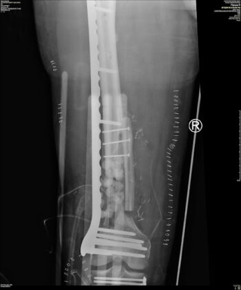 broken leg with pins xray