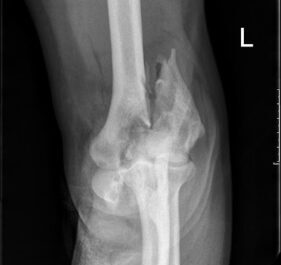 orthopedic trauma surgery xray